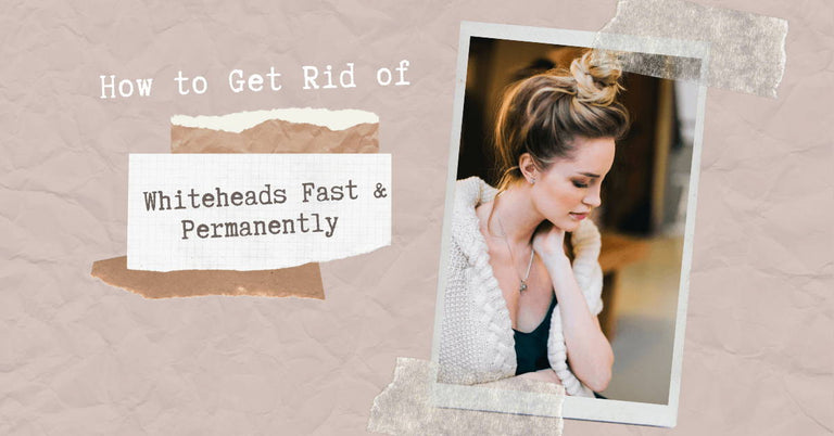 get rid of whiteheads fast and permanently with these tips