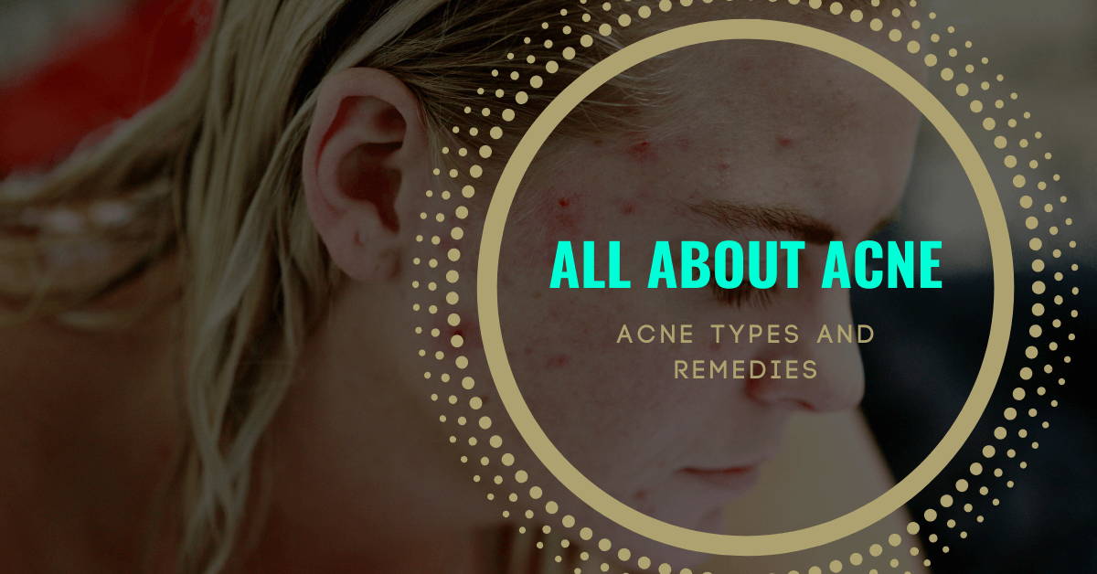 types of acne and the remedies for it