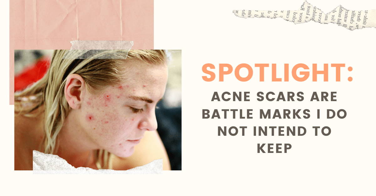 Spotlight: Acne Scars are Battle Marks I Do Not Intend to Keep