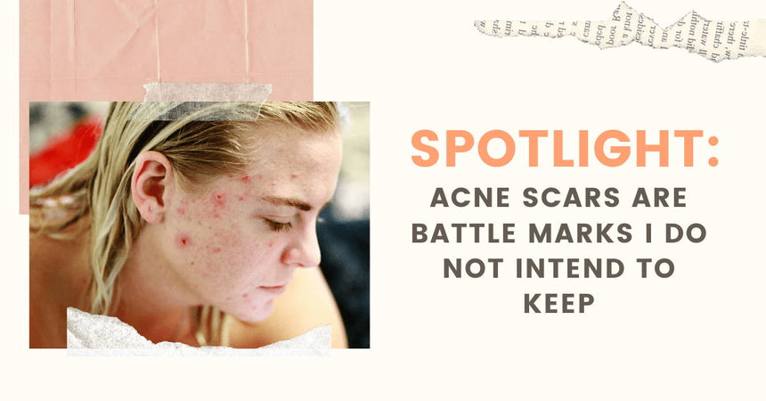 Spotlight: Acne Scars are Battle Marks I Do Not Intend to Keep